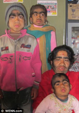Непальская семья с редкой болезнью