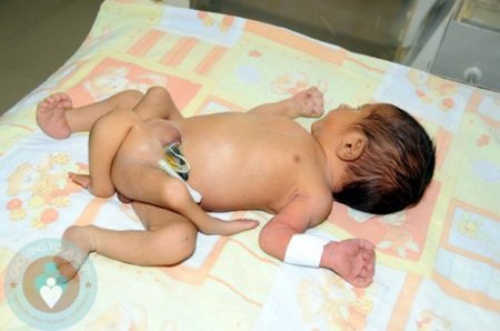 Пакистанского младенца с шестью ногами прооперируют за $300тыс